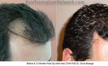Hair transplantation surgery before and after images
