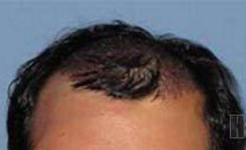 Hair transplant before and after photos - Front view