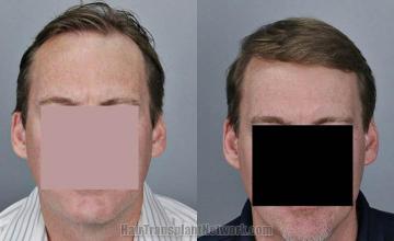 Hair transplantation surgery before and after photos
