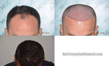 Hair restoration procedure before and after results