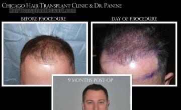 Hair restoration procedure before and after results