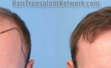 Front View - Before and after hair transplantation surgery