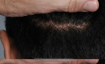 Hair restoration surgery before and after photos