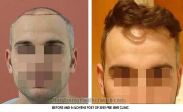 Hair restoration procedure before and after results
