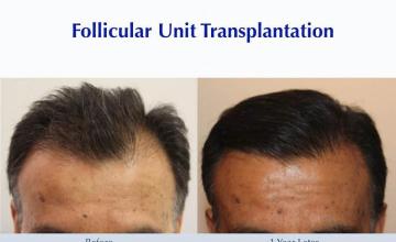 Before and after hair restoration procedure images