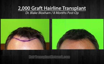 Hair restoration procedure before and after photographs