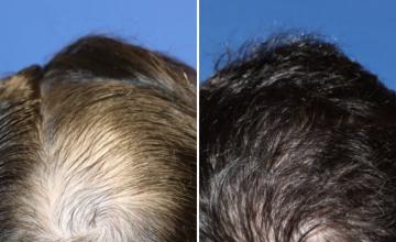 Before and After
