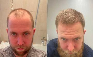Front before and after FUE surgery