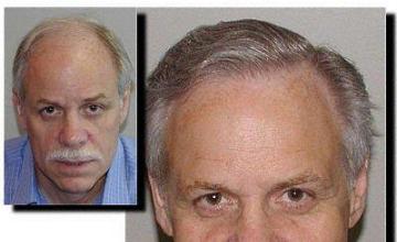Hair restoration procedure results