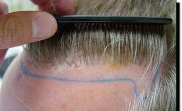 Hair restoration procedure results