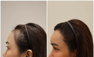 Before and After