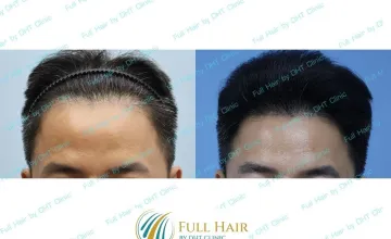Hairline
