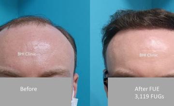 Frontal Before and After 