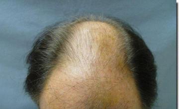 Hair restoration procedure results