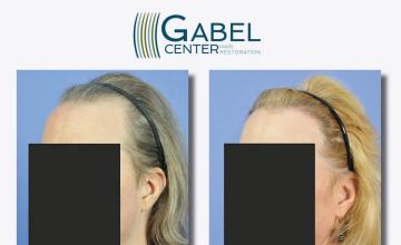 Hair transplant surgery before and after photos