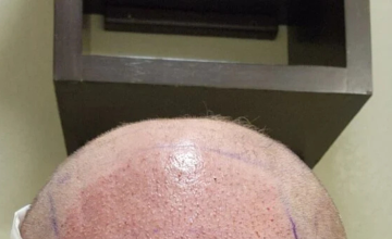 Graft Placement