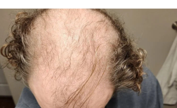 Before and After 