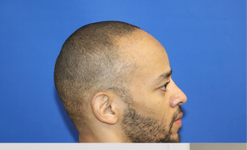 Before and After 