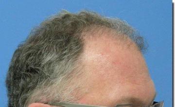 Hair restoration procedure results