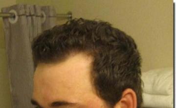 Hair restoration procedure results
