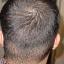 Follicular Unit Grafting 